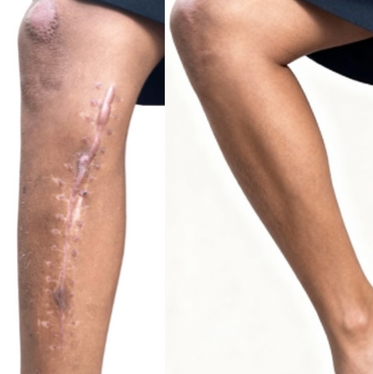 KUBOZN® Triple-Roller Microcurrent ScarRepair Gel