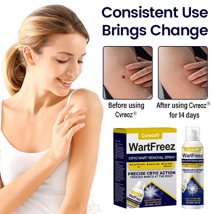 Cvreoz® WartFreez Cryo Wart Removal Spray (Offer)