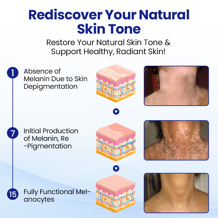 Cvreoz®Vitiligo Treatment Spray — Visible Results in Weeks, 100% Natural & Steroid-Free