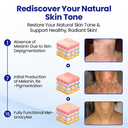 Cvreoz®Vitiligo Treatment Spray — Visible Results in Weeks, 100% Natural & Steroid-Free