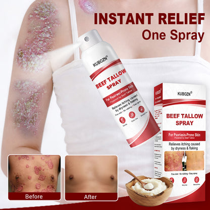 KUBOZN® Beef Tallow Spray for Itchy, Flaky Psoriasis Skin