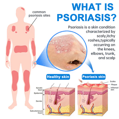 ✅  Official Store: Cvreoz® Magnesium Herbal Psoriasis Spray ⚕️ (Offer)