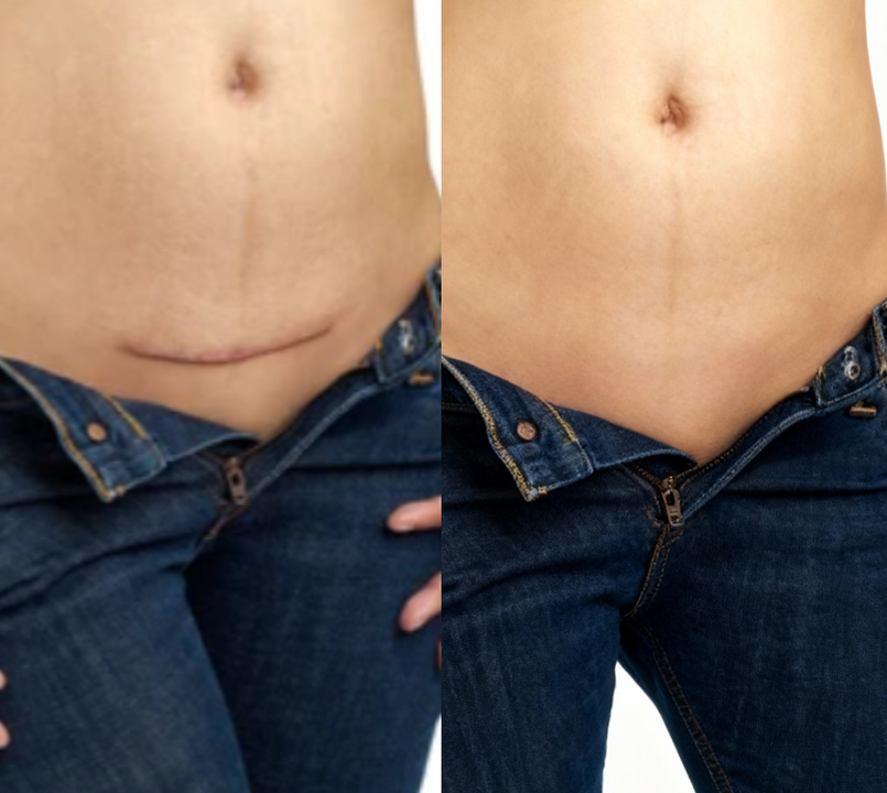 KUBOZN® Triple-Roller Microcurrent ScarRepair Gel