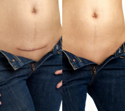 KUBOZN® Triple-Roller Microcurrent ScarRepair Gel