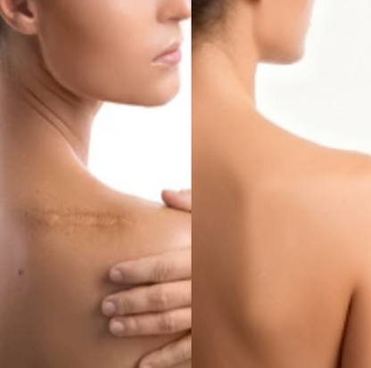 KUBOZN® Triple-Roller Microcurrent ScarRepair Gel