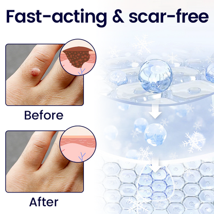 Cvreoz® WartFreez Cryo Wart Removal Spray (Offer)