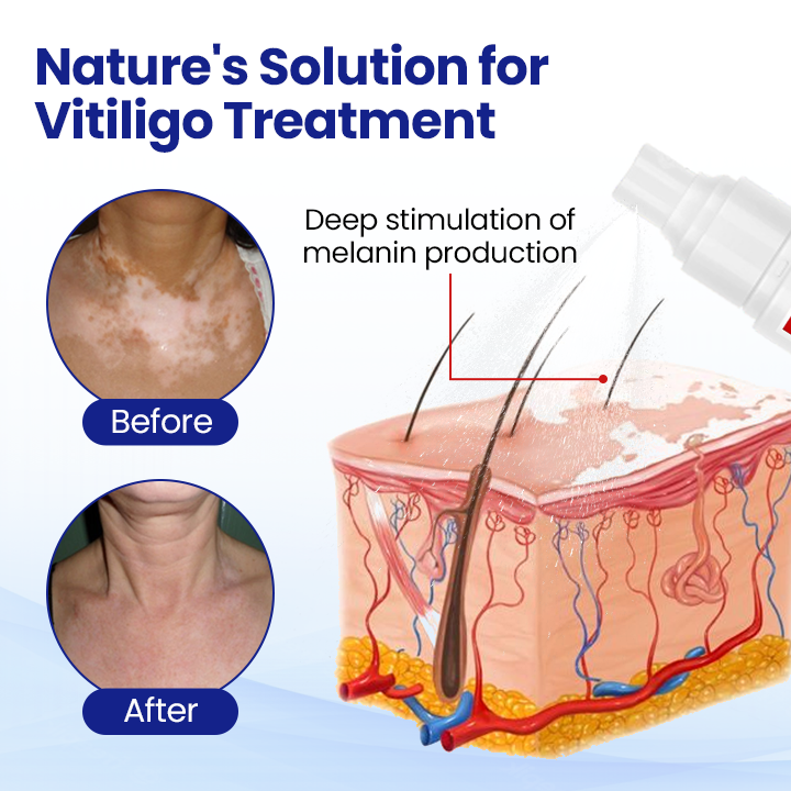 Cvreoz®Vitiligo Treatment Spray — Visible Results in Weeks, 100% Natural & Steroid-Free