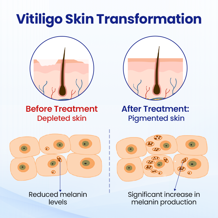 Cvreoz®Vitiligo Treatment Spray — Visible Results in Weeks, 100% Natural & Steroid-Free